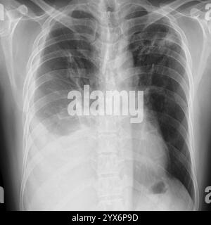 Radiographie des poumons d'un tuberculeux pulmonaire affectant les deux poumons. La tuberculose pulmonaire est causée par la bactérie Mycobacterium tuberculosis, qui se propage par la toux et les éternuements. Les bactéries créent des tubercules primaires, des lésions nodulaires des poumons. Les symptômes comprennent la fièvre, la perte de poids et la toux de sang. Le traitement est avec des antibiotiques à long terme. Banque D'Images