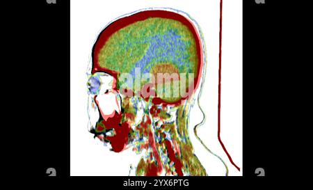 Tomodensitométrie sagittale (TDM) de la tête d'un patient montrant un méningiome (orange, centre). Il s’agit d’une tumeur bénigne (non cancéreuse) qui survient Banque D'Images
