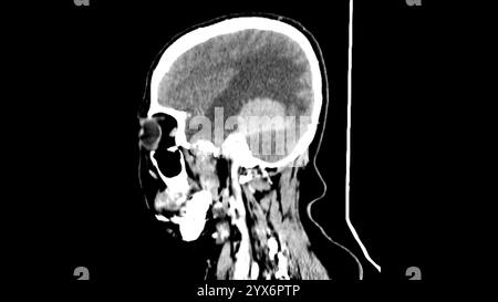 Tomodensitométrie sagittale (TDM) de la tête d'un patient montrant un méningiome (gris clair, centre). Il s’agit d’une tumeur bénigne (non cancéreuse) qui provient des méninges, les membranes qui entourent le cerveau. Banque D'Images