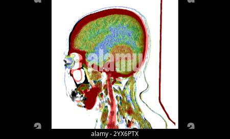 Tomodensitométrie sagittale (TDM) de la tête d'un patient montrant un méningiome (orange, centre). Il s’agit d’une tumeur bénigne (non cancéreuse) qui provient des méninges, les membranes qui entourent le cerveau. Banque D'Images