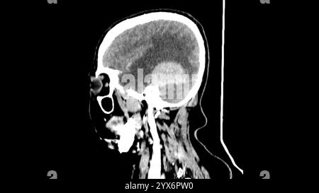 Tomodensitométrie sagittale (TDM) de la tête d'un patient montrant un méningiome (gris clair, centre). Il s’agit d’une tumeur bénigne (non cancéreuse) qui provient des méninges, les membranes qui entourent le cerveau. Banque D'Images