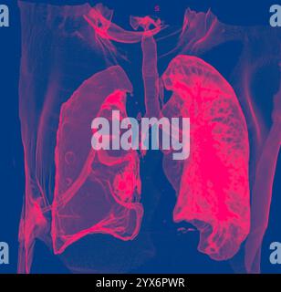 Tomodensitométrie (TDM) colorée du thorax d'un homme de 60 ans atteint d'un pneumothorax ou d'un collapsus pulmonaire. Le poumon droit (vu à gauche) s'est effondré en raison d'une accumulation d'air entre le poumon et la paroi thoracique. Le pneumothorax peut être dû à un traumatisme ou à une rupture pulmonaire. Il provoque un essoufflement et des douleurs à la respiration. Il est traité en insérant un tube pour drainer l'air sur une période de plusieurs jours, permettant au poumon de se gonfler. Banque D'Images