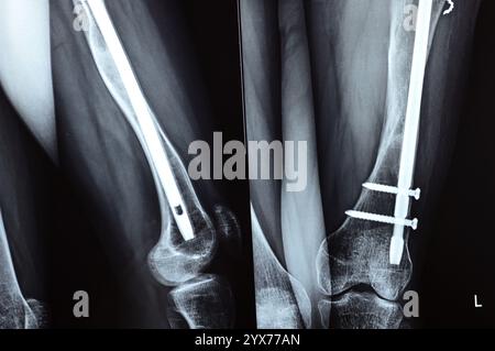 Radiographie montrant une interférence opératoire avec une fracture de la diaphyse fémorale LT transfixatrice intra-médullaire avec formation de cal ossifié, fixation interne Banque D'Images