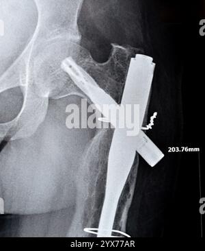 Radiographie montrant une interférence opératoire avec une fracture de la diaphyse fémorale LT transfixatrice intra-médullaire avec formation de cal ossifié, fixation interne Banque D'Images