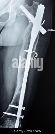 Radiographie montrant une interférence opératoire avec une fracture de la diaphyse fémorale LT transfixatrice intra-médullaire avec formation de cal ossifié, fixation interne Banque D'Images