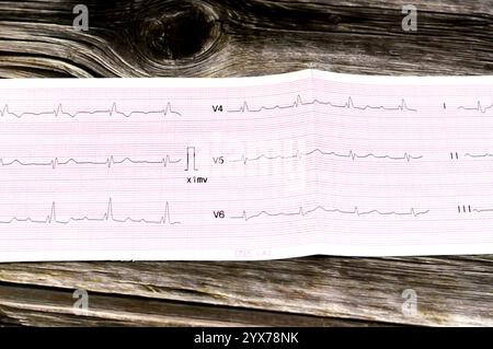 Le Caire, Egypte, 15 novembre 2024 : électrocardiographe ECG, un graphique qui dessine l'électricité du cœur et donne une idée sur la condition cardiaque et t Banque D'Images