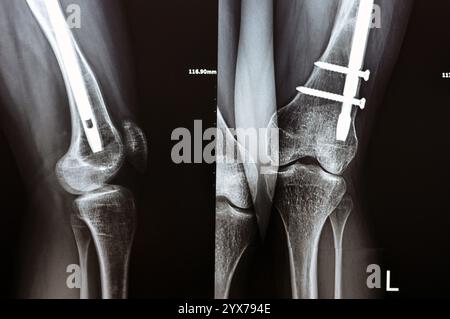 Radiographie montrant une interférence opératoire avec une fracture de la diaphyse fémorale LT transfixatrice intra-médullaire avec formation de cal ossifié, fixation interne Banque D'Images