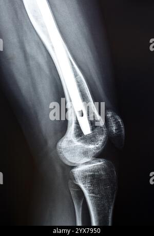 Radiographie montrant une interférence opératoire avec une fracture de la diaphyse fémorale LT transfixatrice intra-médullaire avec formation de cal ossifié, fixation interne Banque D'Images
