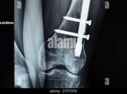 Radiographie montrant une interférence opératoire avec une fracture de la diaphyse fémorale LT transfixatrice intra-médullaire avec formation de cal ossifié, fixation interne Banque D'Images