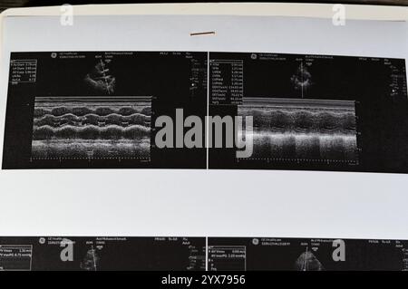 Le Caire, Egypte, 15 novembre 2024 : échographie cardiaque, échocardiographie, une imagerie médicale utilisant l'échographie pour examiner le cœur, en utilisant la norme ou d Banque D'Images