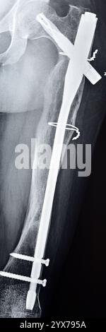 Radiographie montrant une interférence opératoire avec une fracture de la diaphyse fémorale LT transfixatrice intra-médullaire avec formation de cal ossifié, fixation interne Banque D'Images