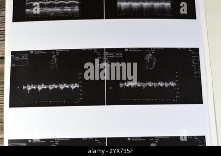 Le Caire, Egypte, 15 novembre 2024 : échographie cardiaque, échocardiographie, une imagerie médicale utilisant l'échographie pour examiner le cœur, en utilisant la norme ou d Banque D'Images