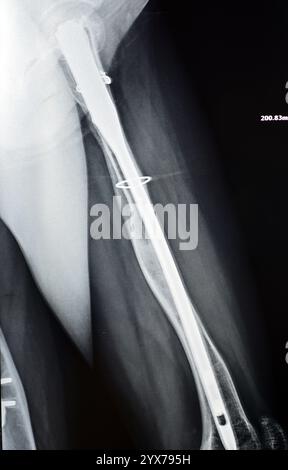 Radiographie montrant une interférence opératoire avec une fracture de la diaphyse fémorale LT transfixatrice intra-médullaire avec formation de cal ossifié, fixation interne Banque D'Images