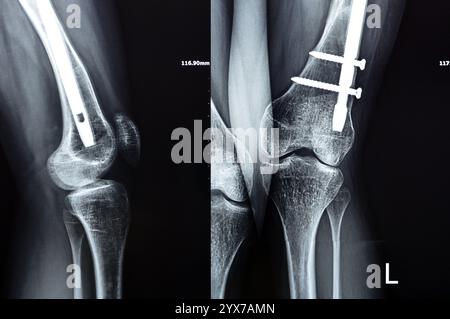 Radiographie montrant une interférence opératoire avec une fracture de la diaphyse fémorale LT transfixatrice intra-médullaire avec formation de cal ossifié, fixation interne Banque D'Images