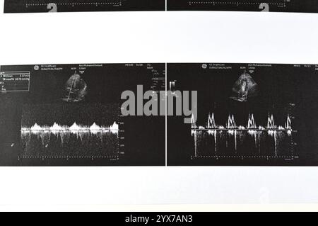 Le Caire, Egypte, 15 novembre 2024 : échographie cardiaque, échocardiographie, une imagerie médicale utilisant l'échographie pour examiner le cœur, en utilisant la norme ou d Banque D'Images