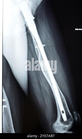 Radiographie montrant une interférence opératoire avec une fracture de la diaphyse fémorale LT transfixatrice intra-médullaire avec formation de cal ossifié, fixation interne Banque D'Images
