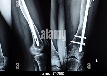 Radiographie montrant une interférence opératoire avec une fracture de la diaphyse fémorale LT transfixatrice intra-médullaire avec formation de cal ossifié, fixation interne Banque D'Images