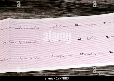 Le Caire, Egypte, 15 novembre 2024 : électrocardiographe ECG, un graphique qui dessine l'électricité du cœur et donne une idée sur la condition cardiaque et t Banque D'Images