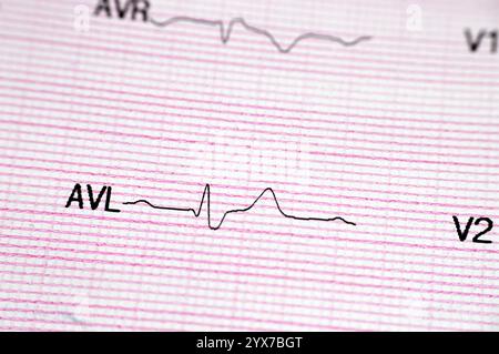 Électrocardiographe ECG, un graphique qui puise l'électricité du cœur et donne une idée sur l'état cardiaque et le rythme et exclut toute angine Banque D'Images