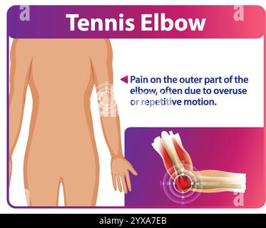 Illustration de la douleur et de l'anatomie du coude de tennis Illustration de Vecteur