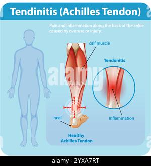 Diagramme montrant l'inflammation et la douleur du tendon d'Achille Illustration de Vecteur