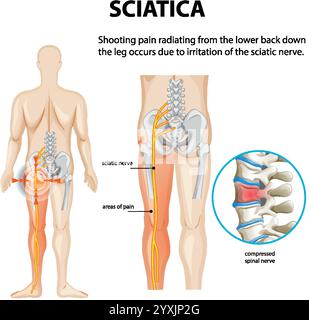 Illustration d'une douleur du nerf sciatique et d'une compression spinale Illustration de Vecteur
