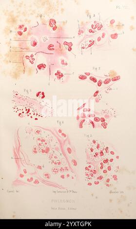 Les bactéries et leur rôle dans l'anatomie et l'histologie pathologiques des maladies infectieuses, Paris, F. Alcan, 1885, Bacteria, infections bactériennes, pathogénicité, pathologie, cette illustration présente diverses vues microscopiques du phlegmon, un type d’infection des tissus mous caractérisée par une inflammation. L'image est divisée en sections étiquetées avec des figures, chacune montrant différentes structures cellulaires et des changements pathologiques associés à la condition. Les étiquettes et les annotations accompagnant le traitement indiquent des caractéristiques spécifiques telles que les cellules inflammatoires, l'architecture tissulaire et le patholo Banque D'Images