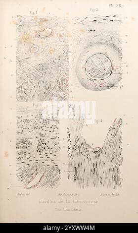 Les, bactéries, et, leur, rôle, dans, l'anatomie, et, l'histologie, pathologiques, des, maladies, infectieuses, Paris, F. Alcan, 1885, bactéries, bactériennes, infections, pathogénicité, pathologie, l'illustration présente une étude détaillée des bacilles tuberculeux, organisés en quatre figures distinctes. Banque D'Images