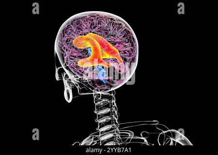 Illustration par ordinateur des ventricules latéraux élargis (hydrocéphalie) du cerveau. Banque D'Images