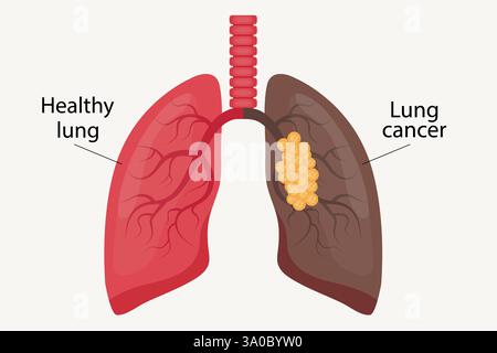 Illustration d'un poumon sain et d'un cancer du poumon. Illustration de Vecteur