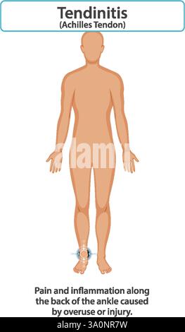 Diagramme montrant la douleur et l'inflammation du tendon d'Achille Illustration de Vecteur