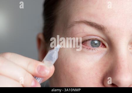 Gros plan d'une femme appliquant des gouttes oculaires sur l'œil rouge infecté avec conjonctivite à la maison Banque D'Images
