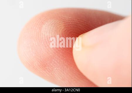 Blessure avec cloque de doigt humain vue macro en gros plan Banque D'Images
