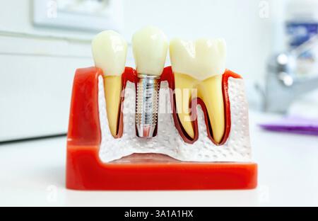 Gros plan d'un modèle d'implant dentaire montrant la vis d'implant, le pilier et la couronne dans une représentation réaliste des gencives et de l'os de la mâchoire Banque D'Images