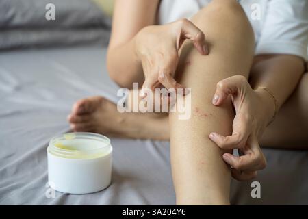 Réaction allergique, démangeaisons, dermatite. La femme applique de la crème, de la pommade sur la peau gonflante contre les piqûres de moustiques, isolé sur fond gris, gros plan Banque D'Images