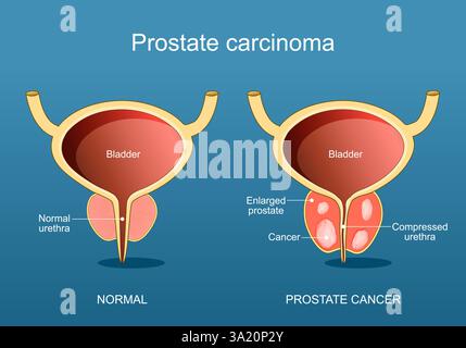 Cancer de la prostate. Adénocarcinome. Coupe transversale d'une vessie humaine et d'une glande prostatique. Trouble de l'appareil reproducteur masculin. Illustration vectorielle. Illustration de Vecteur