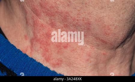 Vue rapprochée d'une éruption cutanée sur le cou humain, détaillée pour l'éducation médicale et les études dermatologiques, mettant en évidence les symptômes d'allergies cutanées ou d'infe Banque D'Images