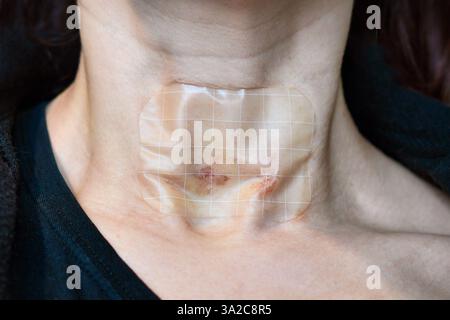 Bandage transparent imperméable à l'eau sur la gorge d'une femme avec plaies après ablation thermique de nodules thyroïdiens intervention médicale Banque D'Images