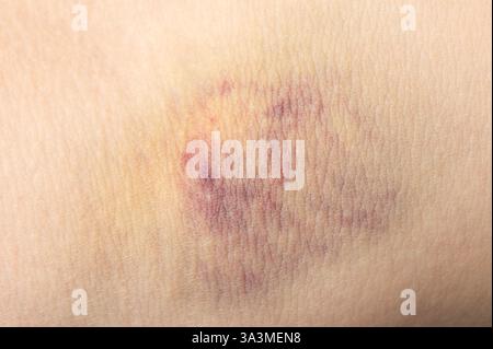 Plaie violette sur peau humaine macro vue rapprochée Banque D'Images