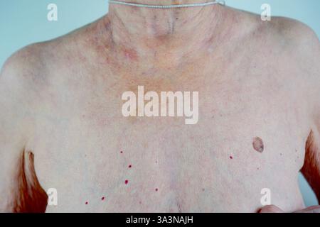 un gros plan du haut du corps d'une femme âgée se concentrant sur la peau âgée avec plusieurs grains de beauté, des taches pigmentaires et des signes visibles de vieillissement. l'image met l'accent sur la santé dermatologique, les risques potentiels pour la peau et l'importance de contrôles médicaux réguliers pour la détection précoce des affections cutanées. Banque D'Images