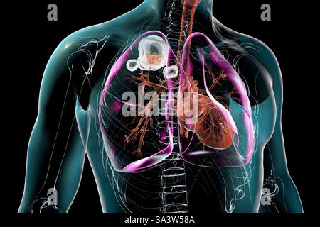 Illustration de tuberculose cavitaire dans le lobe supérieur du poumon droit, organe, organes, montrant des lésions pulmonaires et des cavités. Banque D'Images