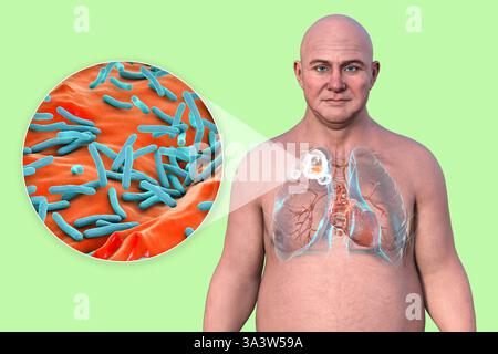 Illustration d'un homme avec des poumons atteints de tuberculose cavitaire dans le lobe supérieur droit, montrant des lésions pulmonaires et des cavités, ainsi qu'une vue rapprochée de la bactérie Mycobacterium tuberculosis. Banque D'Images