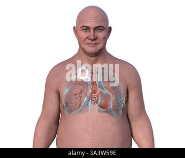 Illustration d'un homme avec des poumons atteints de tuberculose cavitaire dans le lobe supérieur droit, montrant des lésions pulmonaires et des cavités. Banque D'Images