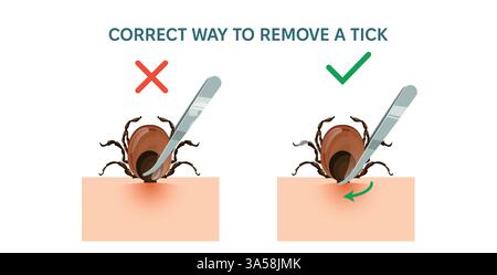 Comment enlever correctement la tique de l'encéphalite après une morsure. Instruction infographique vectorielle de l'élimination des parasites hors de la peau par pince à épiler. Illustration de Vecteur