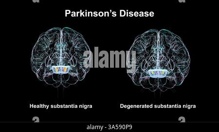 Illustration du cerveau humain avec une substance nigra mise en évidence à l'intérieur d'un mésencéphale (violet) d'un cerveau sain (orange) et d'un cerveau affecté par la maladie de Parkinson (jaune). Dans cette condition, les cellules nerveuses à l'intérieur de la substantia nigra meurent ou deviennent altérées et perdent la capacité de produire de la dopamine, une hormone importante qui joue un rôle dans le mouvement. Banque D'Images