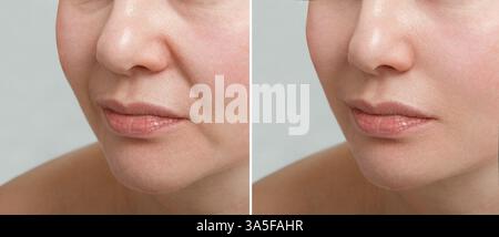 Pli nasolabial féminin avant et après les procédures de lissage des rides. Correction de la forme du menton et du cou. Le résultat de la procédure de rajeunissement Banque D'Images