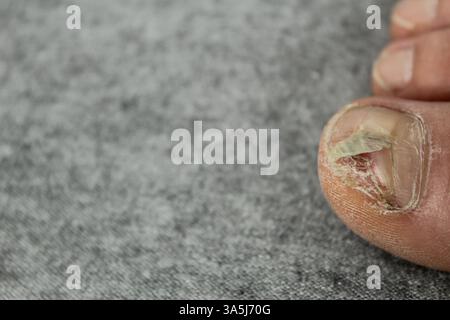 maladies unguéales. Plaque d'ongle détruite, maladies fongiques des pieds. Podologie. Banque D'Images