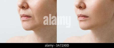 Pli nasolabial féminin avant et après les procédures de lissage des rides. Correction de la forme du menton et du cou. Le résultat de la procédure de rajeunissement Banque D'Images