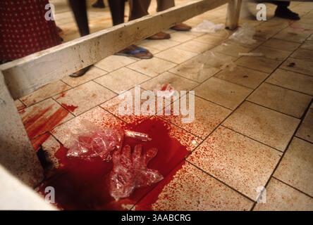 01 août 1992 ; Mogadiscio, SOMALIE ; le sang tache le sol sous une table à l'hôpital Dikfer à Mogadiscio. Un homme avait été amené avec une blessure par balle à la tête et a été laissé à saigner à mort parce que d'autres patients avaient des blessures moins graves qui pourraient être sauvés par une intervention médicale. Il n'y a pas d'électricité, pas de médecins locaux et pas d'approvisionnement en sang à l'hôpital. Les patients doivent arriver avec des membres de leur famille prêts à donner leur sang. Crédit obligatoire : photo de Cheryl Hatch/ZUMA Press. (©) Copyright 1992 par Cheryl Hatch Banque D'Images