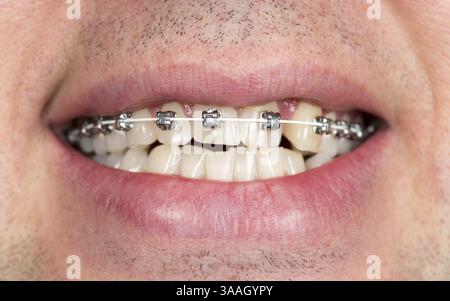 Close-up de crochets sur les dents de la mâchoire supérieure avec les hommes non rasé Banque D'Images